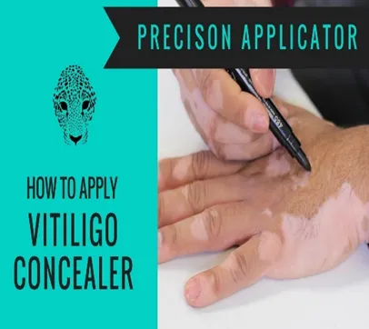Тональный фломастер от витилиго Zanderm Vitiligo Concealer#1