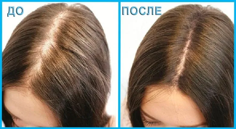 Миноксидил 10% лосьон для волос женский#3