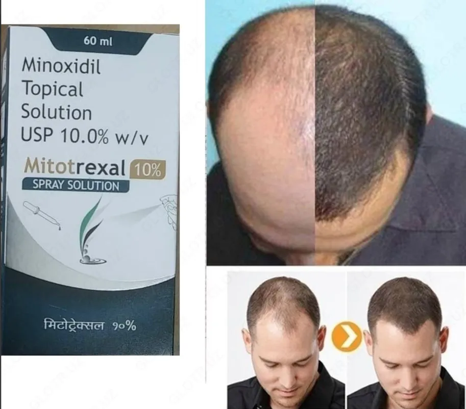 Средство для лечения волос Миноксидил 10% Topical Solution (Mitotrexal 10%)#4
