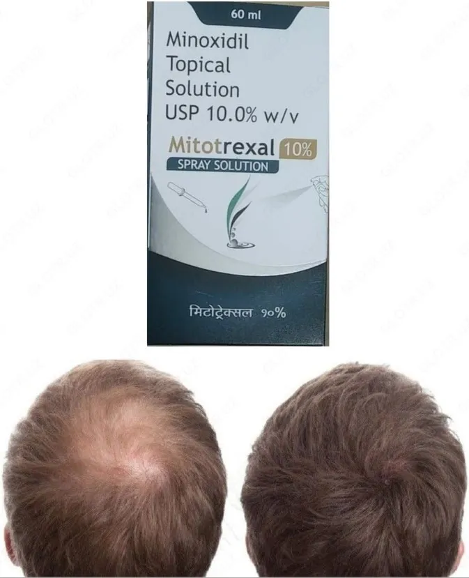 Средство для лечения волос Миноксидил 10% Topical Solution (Mitotrexal 10%)#2