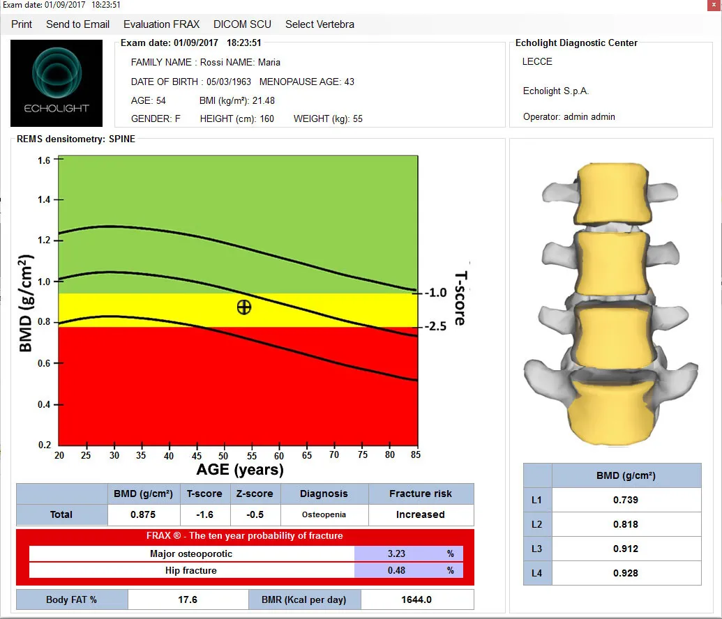 Денситометр Система ранней диагностики остеопороза EchoStation#4