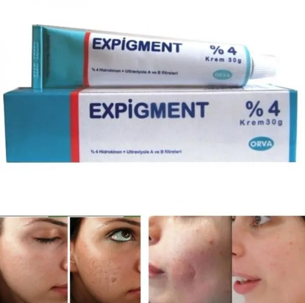 Осветляющий крем при нарушении пигментации кожи Expigment 4% (30 грамм)#6