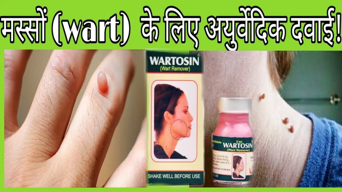 Вартосин от бородавок и папиллом (Wartosin Wart Remover)#7