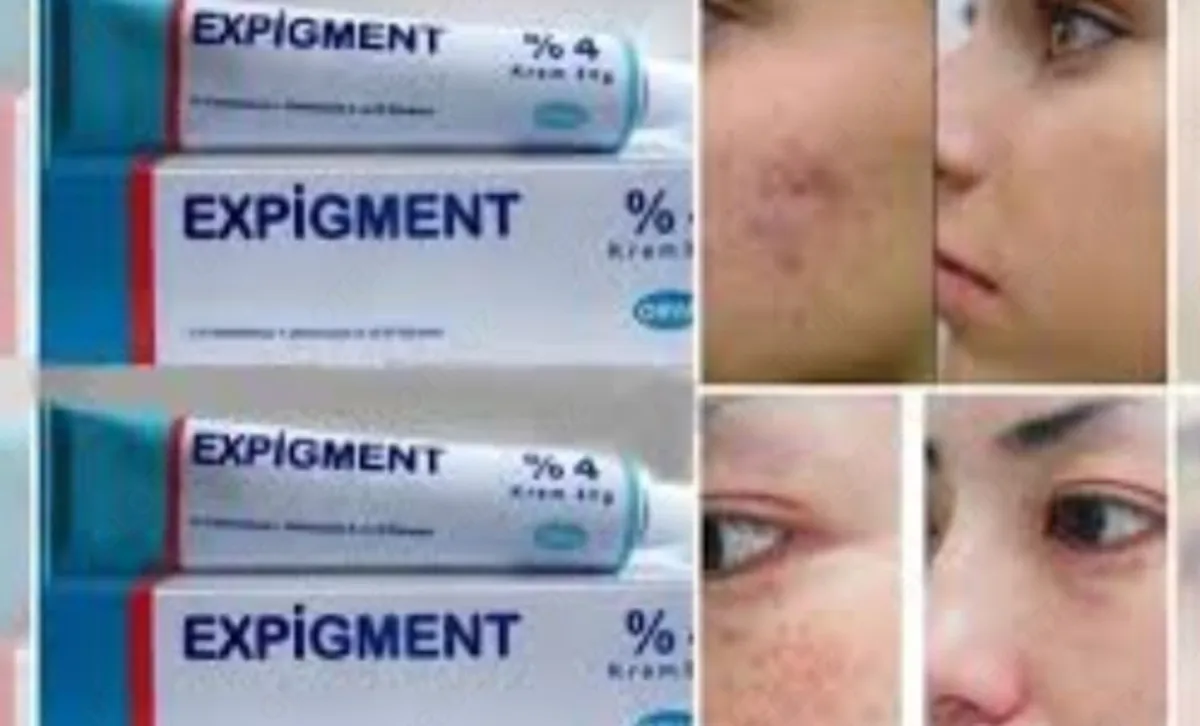 Осветляющий крем при нарушении пигментации кожи Expigment 4% (30 грамм)#2