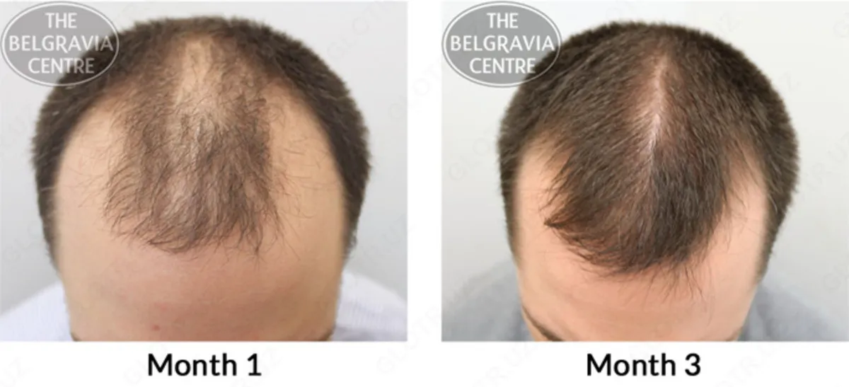 Minoxidil Member's Mark для роста бороды и волос#3