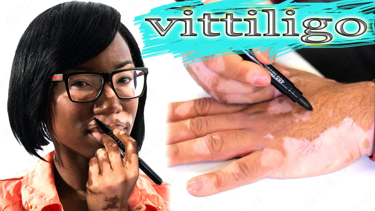 Zanderm spot vitiligo uchun aplikatori#2