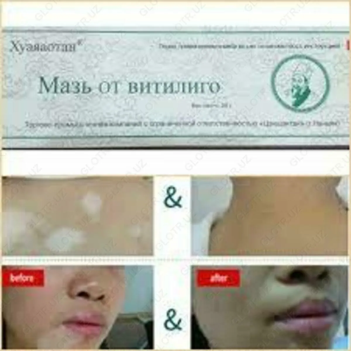 Huayaaotan malhami vitiligo davolash uchun#4