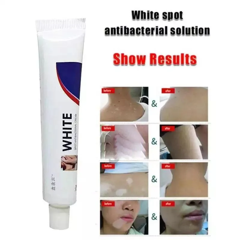 vitiligoga qarshi antibakterial malham#3