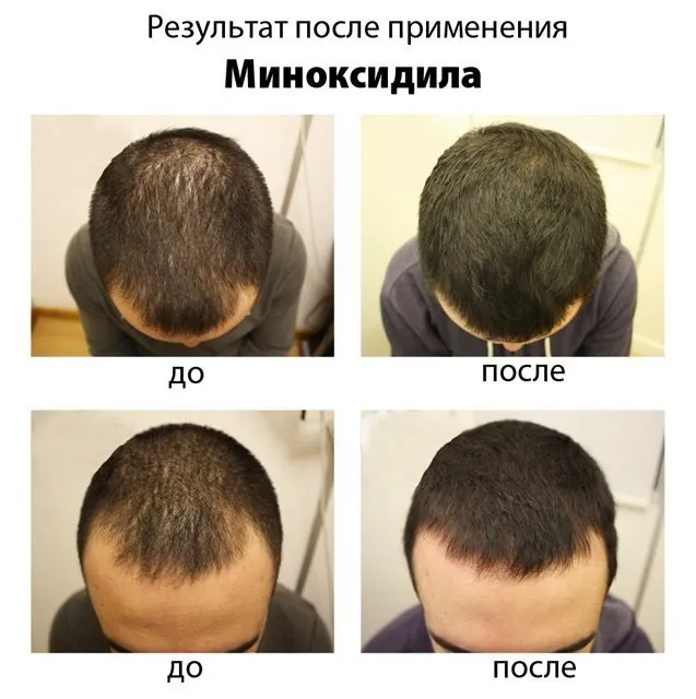 Средство для роста волос Minoxidil 10%  (Таиланд)#3
