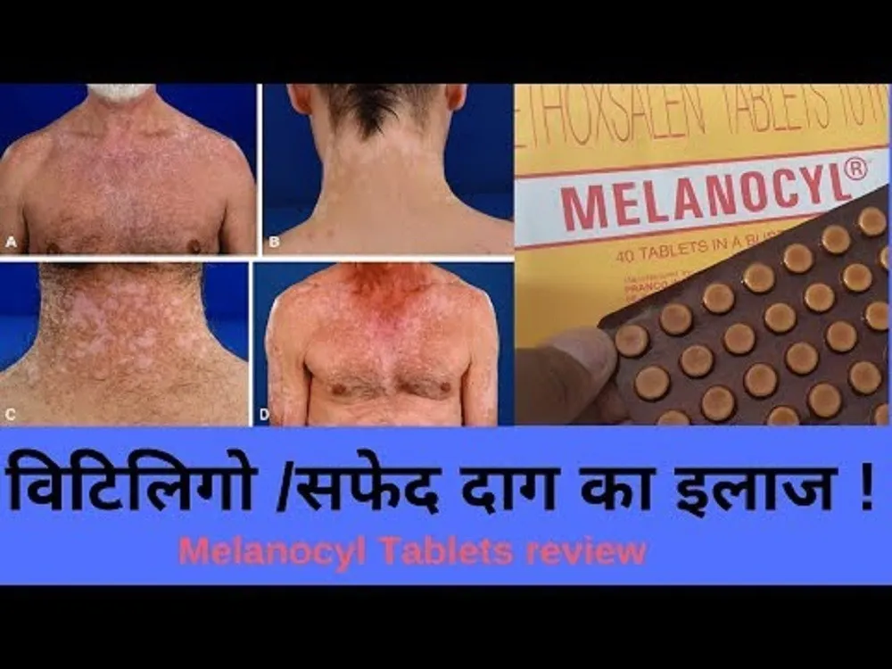 Vitiligo uchun melanocyl (Melanocyl) tabletkalari#2