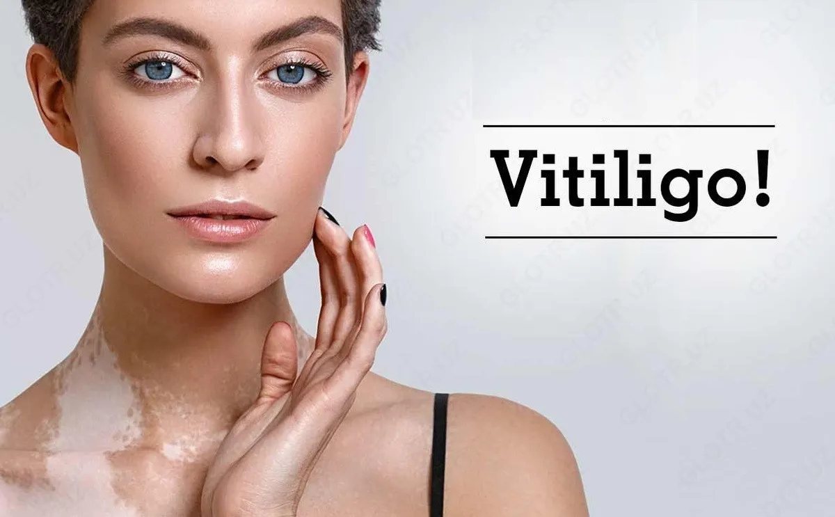Psoriaz va vitiligoni davolash uchun malham Melanocil (Melanocyl)#4