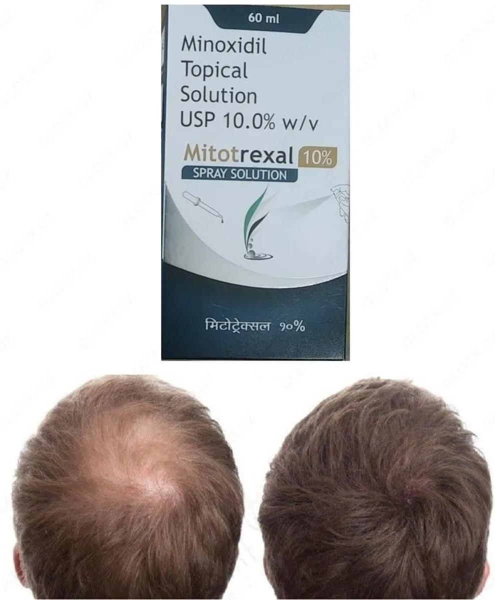 Mitotrexal для роста волос (Minoxidil 10%)#4