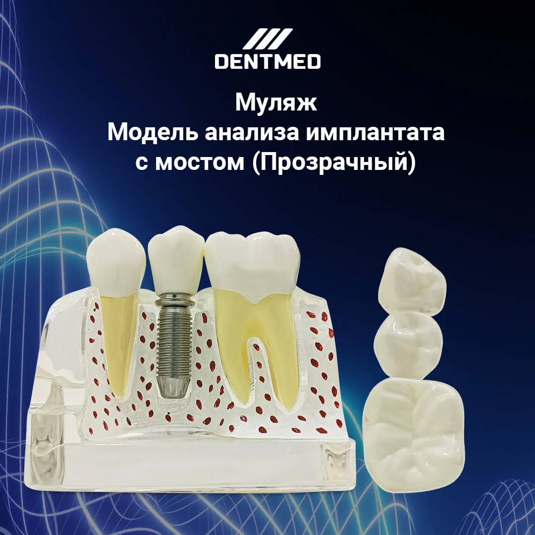 Муляж Implant analysis model with bridge/Модель анализа имплантата с мостом (Прозрачный)#1