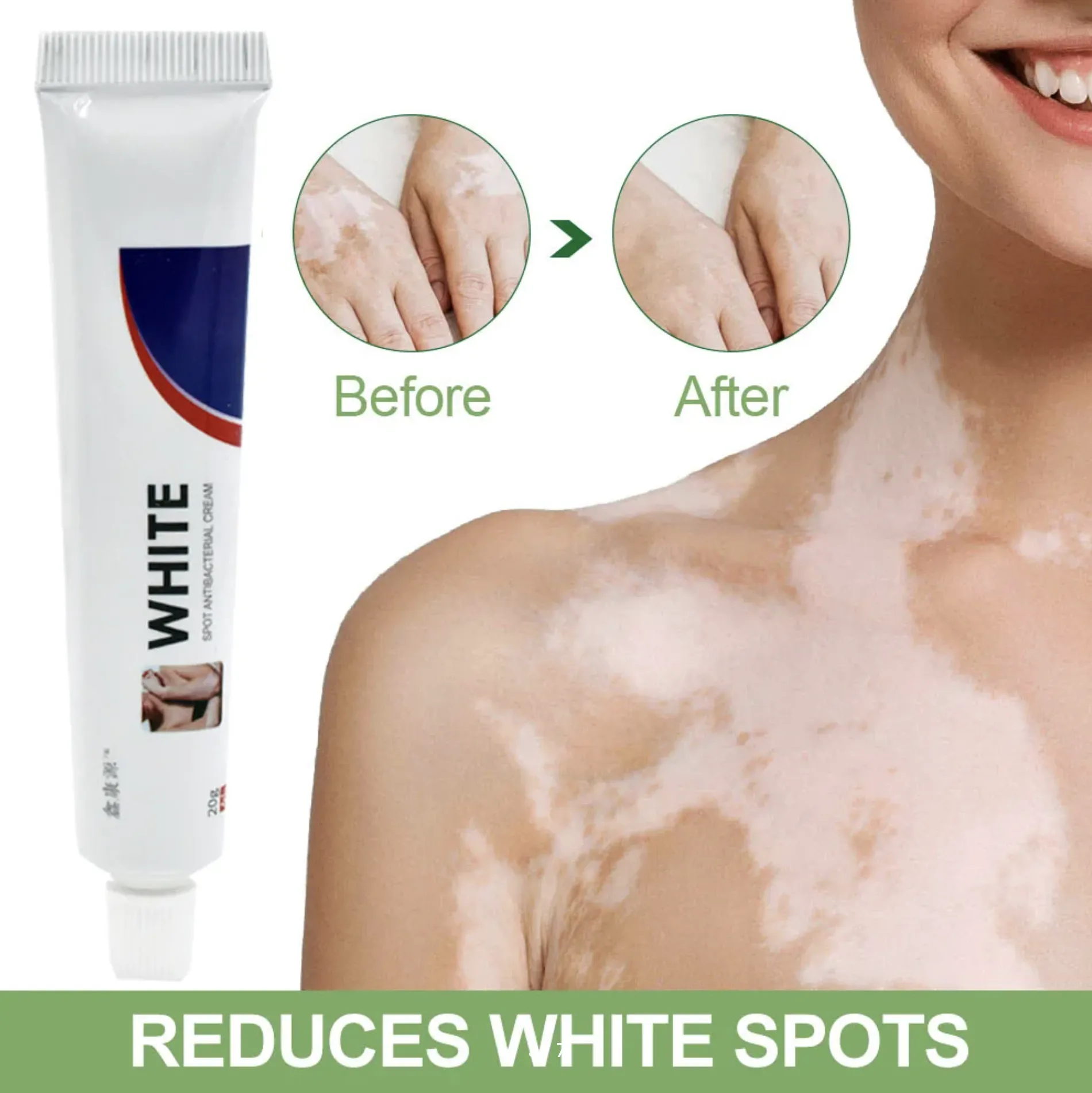 Oq-vitiligo davolash uchun krem, 20 g#1