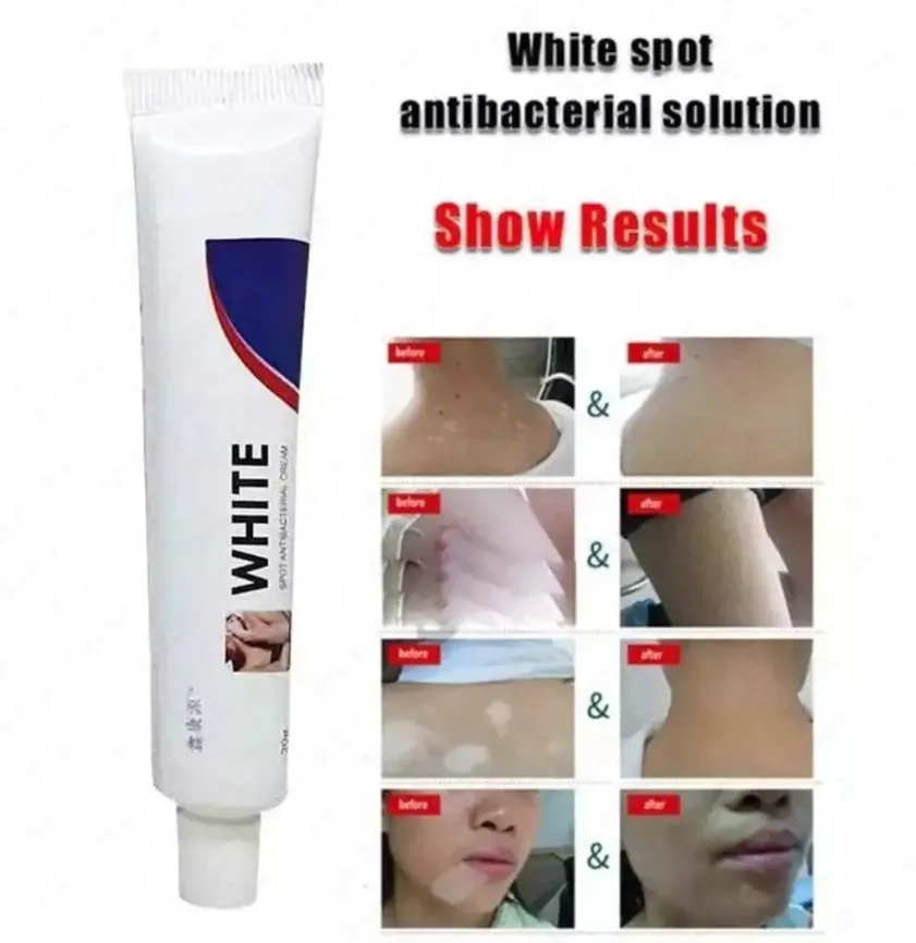 Vitiligo oq dog'lar uchun antibakterial krem#1