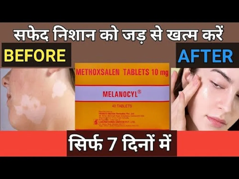 Vitiligo uchun melanocyl (Melanocyl) tabletkalari#1
