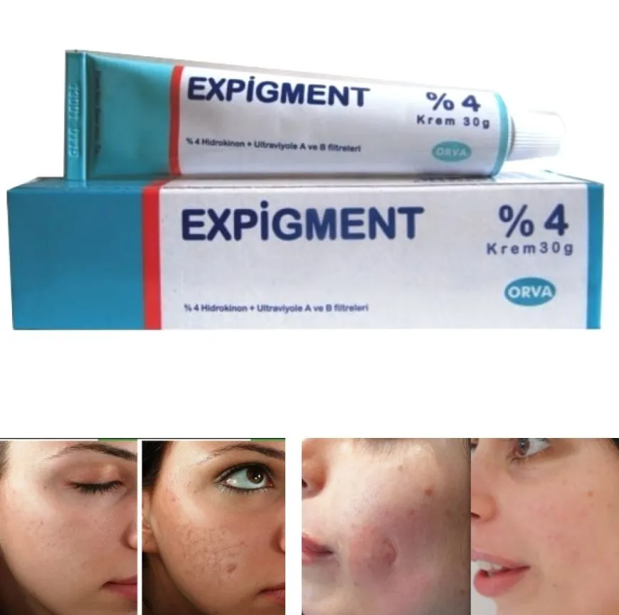 Осветляющий крем при нарушении пигментации кожи Expigment 4% (30 грамм)#1