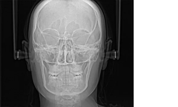 Цифровая панорамная/томографическая стоматологическая система FONA STELLARIS 3D с Цефлостата#4