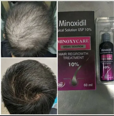 Препарат Minoxidil 10% - 60мл.