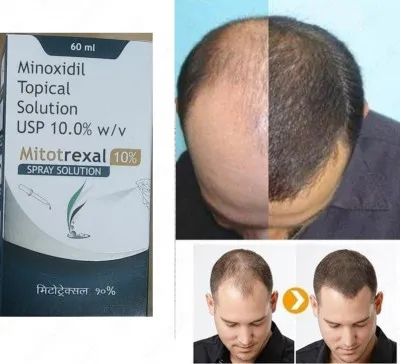 Mitotrexal для роста волос (Minoxidil 10%)